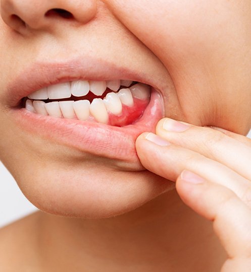 Closeup of patient with red, inflammed gums